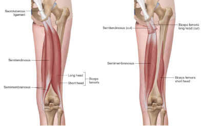 Complete Guide to Hamstring Strains: Recovery, Timelines, and Rehab ...