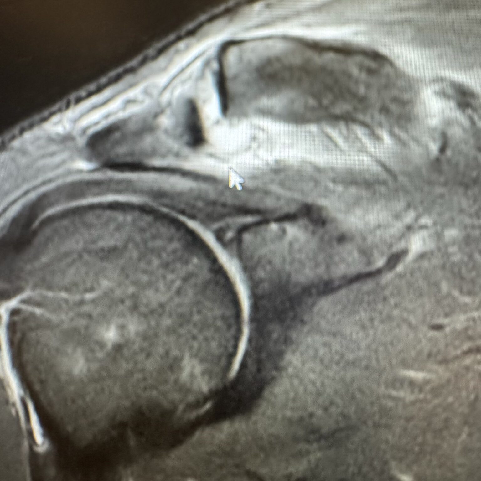 MRI AC sepeartion | Adam Loiacono