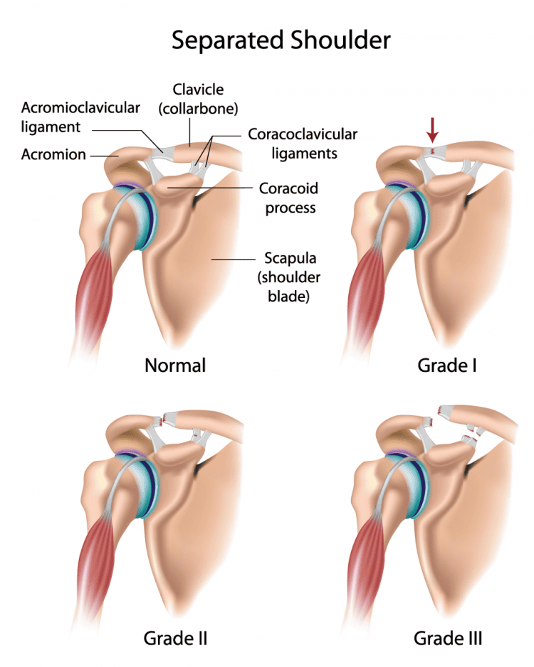 separated-shoulderpng | Adam Loiacono