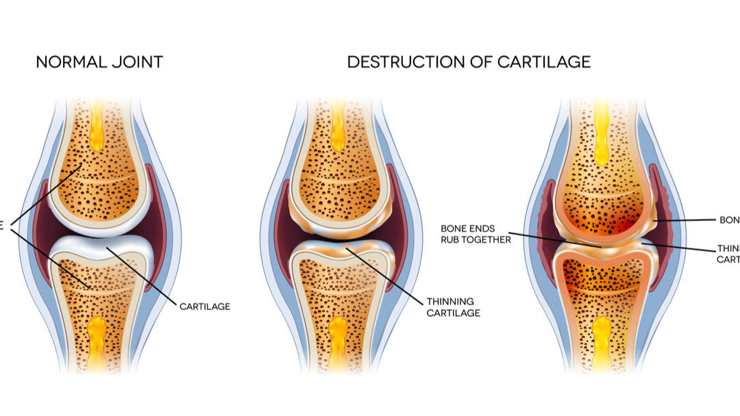 cartilage | Adam Loiacono